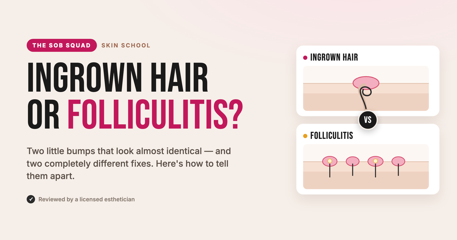 Ingrown hair or folliculitis? Two lookalike bumps compared side by side, a single trapped-hair ingrown versus a cluster of inflamed follicles, from Crybaby Wax Skin School