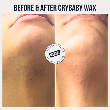 Before and after at-home PCOS chin and upper-lip waxing with Crybaby Wax, smooth hair-free results on coarse hormonal facial hair