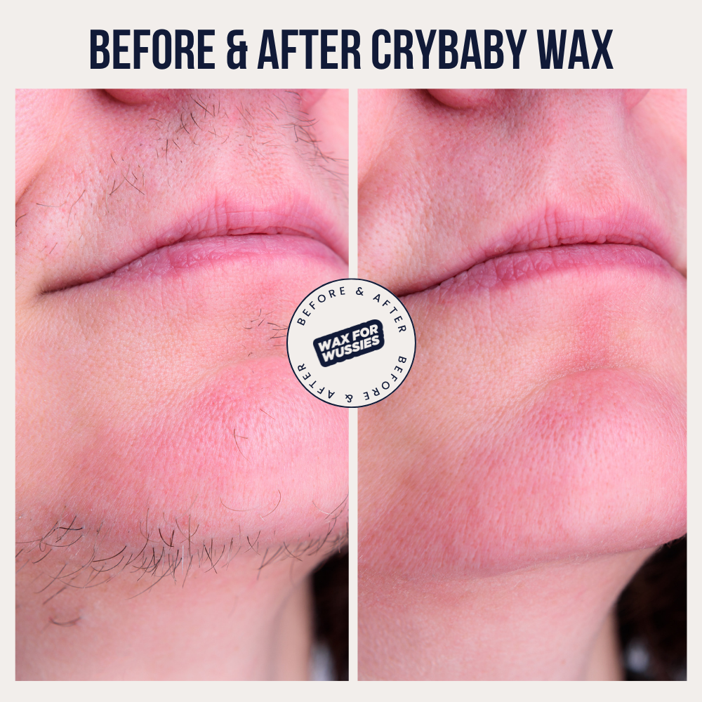 Before and after Crybaby Wax facial waxing on the upper lip and chin, coarse hair removed from the root for smooth, hair-free skin