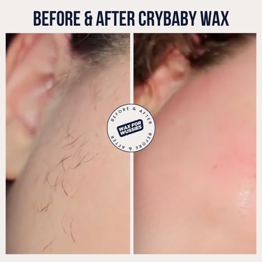 Before and after Crybaby Wax on the jaw and neck, coarse facial hair removed for smooth skin