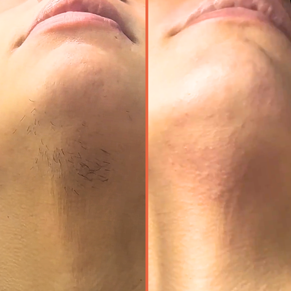 Crybaby PCOS Facial Hair Kit with vegan hard wax for chin, upper-lip, and sideburn waxing