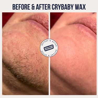 Before and after PCOS facial hair removal with Crybaby Wax I'm Sensitive Meltdown vegan hard wax