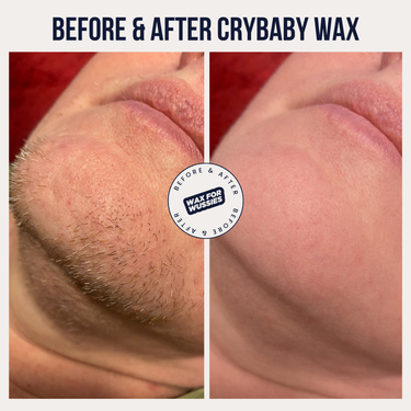 Before and after Crybaby Wax on the jaw and chin, coarse facial hair removed for smooth skin