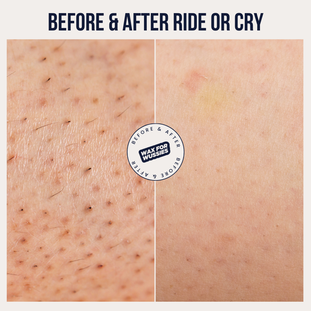 PCOS Facial Hair Removal Kit – Crybaby Wax